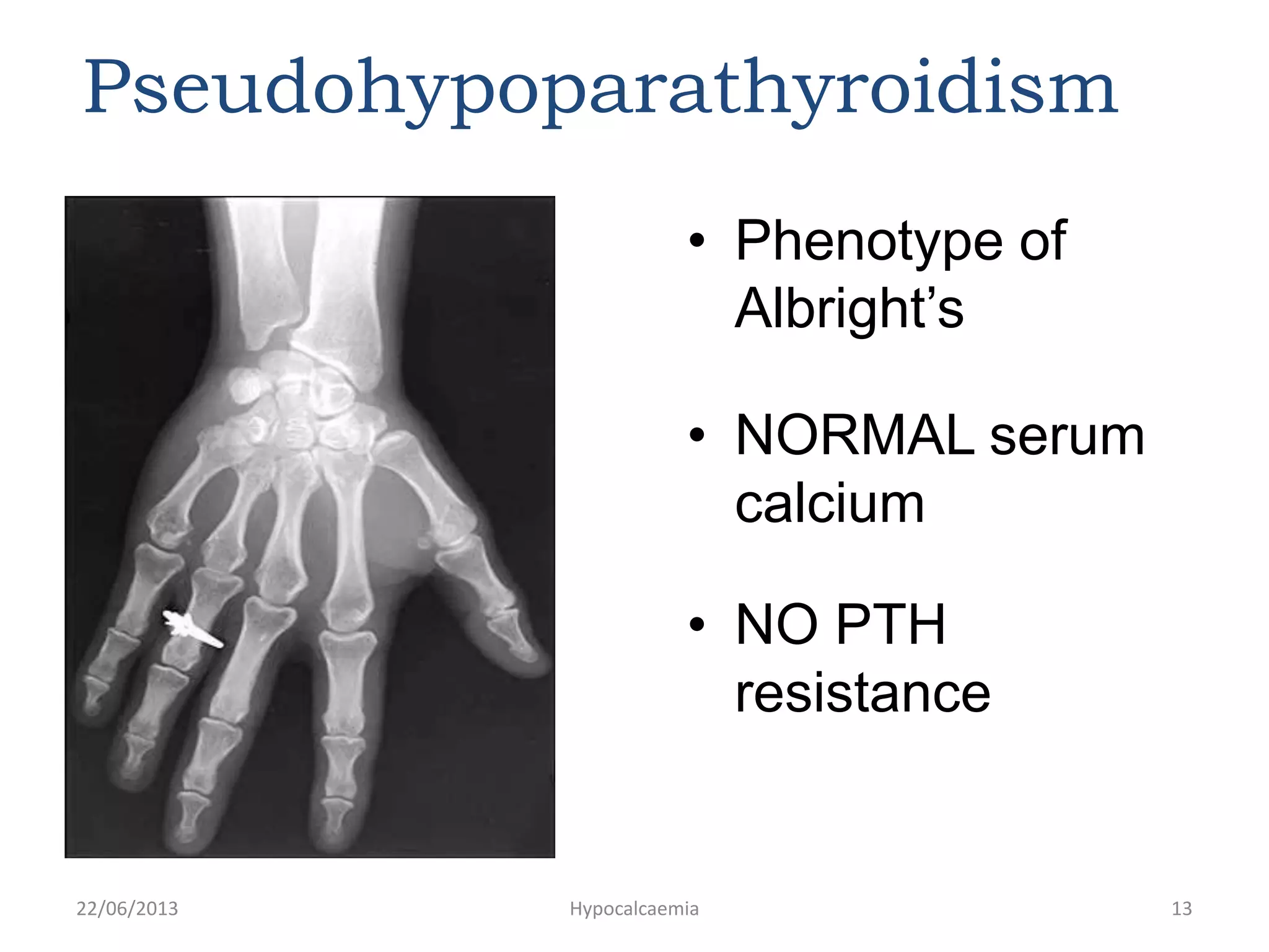 Pseudohypoparathyroidism
• Phenotype of
Albright’s
• NORMAL serum
calcium
• NO PTH
resistance
22/06/2013 Hypocalcaemia 13
 
