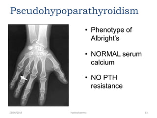 Pseudohypoparathyroidism
• Phenotype of
Albright’s
• NORMAL serum
calcium
• NO PTH
resistance
22/06/2013 Hypocalcaemia 13
 