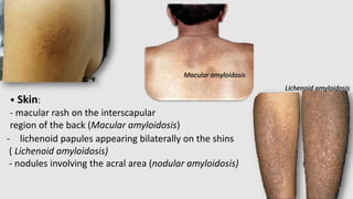Amylodosis | PPTX