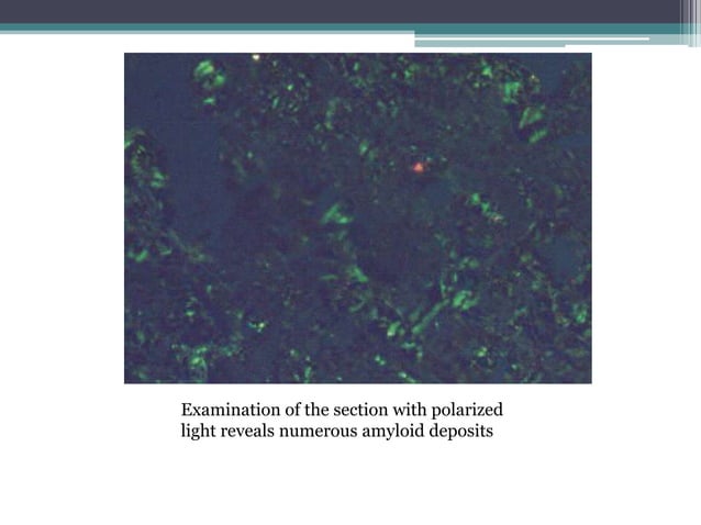 Amyloid | PPTX | Blood Disorders | Diseases and Conditions