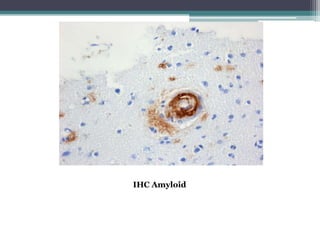 Amyloid | PPTX