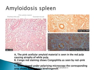 www.dentaltutor.in
A, The pink acellular amyloid material is seen in the red pulp
causing atrophy of while pulp.
B, Congo red staining shows Congophilia as seen by red-pink
colour.
C, When viewed under polarising microscopy the corresponding
area shows apple-green birefringence.
 