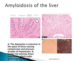 www.dentaltutor.in
A, The deposition is extensive in
the space of Disse causing
compression and pressure
atrophy of hepatocytes. B,
Congo red staining shows
congophilia which under
polarising microscopy.
 