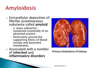  Extracellular deposition of
fibrillar proteinaceous
substance called amyloid
◦ a ‘waxy substance’
composed essentially of an
abnormal protein
◦ Particularly around the
supporting fibres of blood
vessels and basement
membranes.
 Associated with a number
of inherited and
inflammatory disorders
www.dentaltutor.in
Primary Amyloidosis of kidneys
 