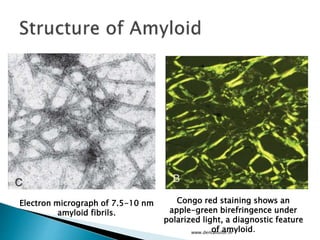 www.dentaltutor.in
Electron micrograph of 7.5-10 nm
amyloid fibrils.
Congo red staining shows an
apple-green birefringence under
polarized light, a diagnostic feature
of amyloid.
 