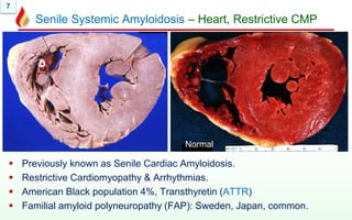 7
Senile Systemic Amyloidosis – Heart, Restrictive CMP
 Previously known as Senile Cardiac Amyloidosis.
 Restrictive Cardiomyopathy & Arrhythmias.
 American Black population 4%, Transthyretin (ATTR)
 Familial amyloid polyneuropathy (FAP): Sweden, Japan, common.
Normal
 