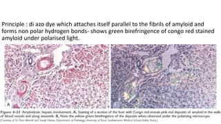 Principle : di azo dye which attaches itself parallel to the fibrils of amyloid and
forms non polar hydrogen bonds- shows green birefringence of congo red stained
amyloid under polarised light.
 