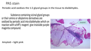 PAS stain
Periodic acid oxidises the 1:2 glycol groups in the tissue to dialdehydes.
Amyloid – light pink
 