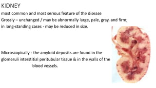 KIDNEY
most common and most serious feature of the disease
Grossly – unchanged / may be abnormally large, pale, gray, and firm;
in long-standing cases - may be reduced in size.
Microscopically - the amyloid deposits are found in the
glomeruli interstitial peritubular tissue & in the walls of the
blood vessels.
 