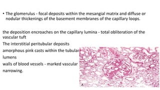 • The glomerulus - focal deposits within the mesangial matrix and diffuse or
nodular thickenings of the basement membranes of the capillary loops.
the deposition encroaches on the capillary lumina - total obliteration of the
vascular tuft
The interstitial peritubular deposits
amorphous pink casts within the tubular
lumens
walls of blood vessels - marked vascular
narrowing.
 