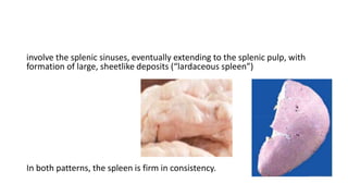 involve the splenic sinuses, eventually extending to the splenic pulp, with
formation of large, sheetlike deposits (“lardaceous spleen”)
In both patterns, the spleen is firm in consistency.
 