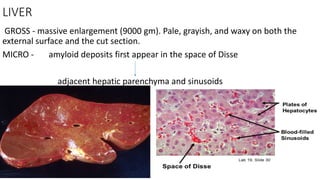 LIVER
GROSS - massive enlargement (9000 gm). Pale, grayish, and waxy on both the
external surface and the cut section.
MICRO - amyloid deposits first appear in the space of Disse
adjacent hepatic parenchyma and sinusoids
 