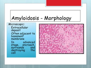 Amyloidosis - Morphology
Microscopic:
- Extracellular
deposit
- Often adjacent to
basement
membrane
- In advanced
stage, encroach,
surrounds and
destroying the
cell
 