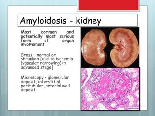 Amyloidosis - kidney
Most common and
potentially most serious
form of organ
involvement
Gross – normal or
shrunken [due to ischemia
(vascular narrowing) in
advanced stage]
Microscopy – glomerular
deposit, interstitial,
peritubular, arterial wall
deposit
 