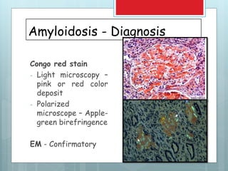 Amyloidosis - Diagnosis
Congo red stain
- Light microscopy –
pink or red color
deposit
- Polarized
microscope – Apple-
green birefringence
EM - Confirmatory
 