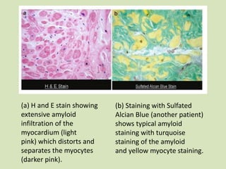 (a) H and E stain showing
extensive amyloid
infiltration of the
myocardium (light
pink) which distorts and
separates the myocytes
(darker pink).
(b) Staining with Sulfated
Alcian Blue (another patient)
shows typical amyloid
staining with turquoise
staining of the amyloid
and yellow myocyte staining.
 