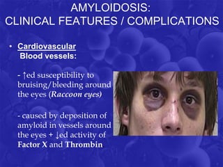 AMYLOIDOSIS:
CLINICAL FEATURES / COMPLICATIONS
• Cardiovascular
Blood vessels:
- ↑ed susceptibility to
bruising/bleeding around
the eyes (Raccoon eyes)
- caused by deposition of
amyloid in vessels around
the eyes + ↓ed activity of
Factor X and Thrombin.
 