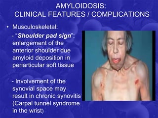 AMYLOIDOSIS:
CLINICAL FEATURES / COMPLICATIONS
• Musculoskeletal:
- “Shoulder pad sign”:
enlargement of the
anterior shoulder due
amyloid deposition in
periarticular soft tissue
- Involvement of the
synovial space may
result in chronic synovitis
(Carpal tunnel syndrome
in the wrist)
 