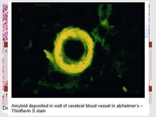 APPEARANCE
STAIN APPEARANCE
H and E Acellular, amorphous, eosinophilic,
refractile, extracellular substance.
CONGO RED On H&E – pink red
On polarizing microscopy – apple green
birefringence
GOLD STANDARD
THIOFLAVIN S Green
 
