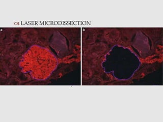  LASER MICRODISSECTION
• laser microbe
• melts a thermoplastic ethyl vinyl acetate membrane
that overlays the tissue
• sticks to the selected cells, which can then be lifted
• secured in a microfuge tube containing the
appropriate extraction solution
• Gold standard
PITFALL- Availability
 