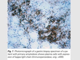  most aggressive -13 mnths
 kidney and heart are most commonly affected
 Histologically, AL deposits can be found in all three
compartments of the kidney
-glomerulus:minimal to massive
-interstitium
-the wall of blood vessels.
 Treatment of AL - advanced considerably
- ﬁrst effective treatment :melphalan and prednisone (MP).
- high dose melphalan followed by autologous STC
-renal transplantation
AL
 