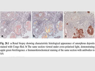  Histologically, one feature that is particular but not
unique to AA is the formation of crescents -most
commonly in AA secondary to rheumatoid arthritis.
 Often associated with rapidly progressive
glomerulonephritis and rapid loss in renal function.
 Corticosteroids- effective at stabilizing and reversing the
rapid loss in renal function
 Treatment - eliminating or controlling the underlying
disease
 Reversible
 
