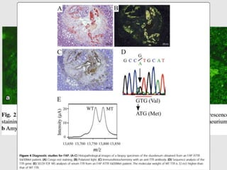  AD inheritance
 most commonly- transthyretin gene
 Familial amyloidotic polyneuropathy
 Familial amyloidotic cardiomyopathy
 >130 mutations-Val30Met
 Microscopy
- amyloid deposition in endoneurium of nerve trunks,
plexuses and sensory and autonomic ganglia
- destruction of the myelin sheath
 Treatment- liver transplantation
FAMILIAL AMYLOIDOSIS
 