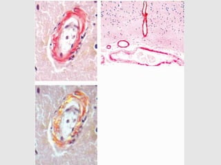 ORGAN WISE
AMYLOID ANGIOPATHY
• CNS
• Localised form
• Familial hereditary amyloidosis
• Beta amyloid
• Features- leukoencephalopathy
-microinfarcts
-hemosiderin deposits
 