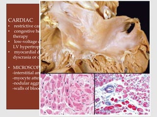 CARDIAC
• restrictive cardiomyopathy
• congestive heart failure remains refractory to maximal medical
therapy
• low-voltage changes on electrocardiogram associated with marked
LV hypertrophy
• myocardial dysfunction in the setting of known plasma cell
dyscrasia or connective tissue disorder.
• MICROSCOPY
-interstitial and perimyocyte deposition
-myocyte attenuation
-nodular aggregates
-walls of blood vessels: subendocardial
 