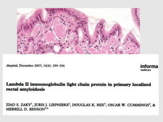 GIT
• Primary (AL)- blood vessel walls and muscularis
propria
• Secondary(AA)- blood vessel wall and lamina propria
lacks the surface epithelial damage and epithelial
lymphocytosis
 