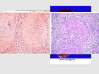 SPLEEN
Two patterns
Deposition in follicles Deposition in walls of sinuses
(SAGO SPLEEN) In red pulp
- LARDACEOUS
SPLEEN
Later fusion of both areas gives the appearance of map like
areas in the spleen
 