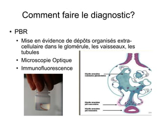 Comment faire le diagnostic? PBR Mise en évidence de dépôts organisés extra-cellulaire dans le glomérule, les vaisseaux, les tubules Microscopie Optique Immunofluorescence 
