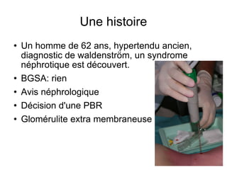 Une histoire Un homme de 62 ans, hypertendu ancien, diagnostic de waldenström, un syndrome néphrotique est découvert. BGSA: rien Avis néphrologique Décision d'une PBR  Glomérulite extra membraneuse 
