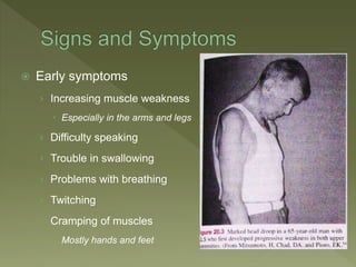  Early symptoms
› Increasing muscle weakness
 Especially in the arms and legs
› Difficulty speaking
› Trouble in swallowing
› Problems with breathing
› Twitching
› Cramping of muscles
 Mostly hands and feet
 