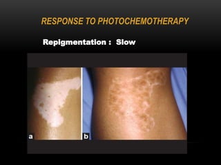 RESPONSE TO PHOTOCHEMOTHERAPY
Repigmentation : Slow
 