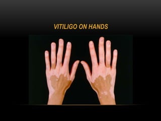 VITILIGO ON HANDS
 