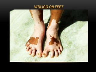 VITILIGO ON FEET
 