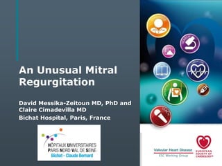 An Unusual Mitral
Regurgitation
David Messika-Zeitoun MD, PhD and
Claire Cimadevilla MD
Bichat Hospital, Paris, France

 