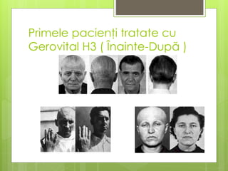 Primele pacienţi tratate cu
Gerovital H3 ( Înainte-După )
 