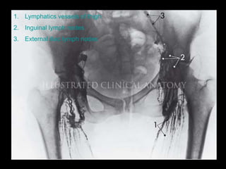 1. Lymphatics vessels of thigh
2. Inguinal lymph nodes
3. External iliac lymph nodes
 