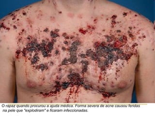O rapaz quando procurou a ajuda médica. Forma severa de acne causou feridas
na pele que "explodiram" e ficaram infeccionadas.
 