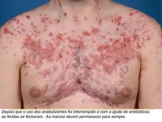Depois que o uso dos anabolizantes foi interrompido e com a ajuda de antibióticos,
as feridas se fecharam. As marcas devem permanecer para sempre.
 