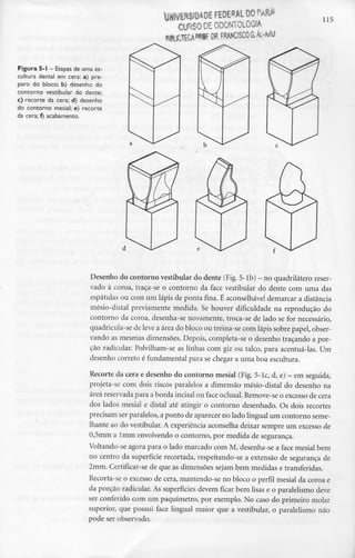 !HIVER$IOADE FEDERAL 00r^RÃ
CURSO DE ODONTOLOGIA
FRANCISCOG.ÁL-AW
115
Figura 5-1 - Etapas de uma es-
cultura dental em cera: a) pre-
paro do bloco; b) desenho do
contorno vestibular do dente;
c) recorte da cera; d) desenho
do contorno mesial; e) recorte
da cera; f) acabamento.
Desenho do contorno vestibular do dente (Fig. 5-lb) - no quadrilátero reser-
vado à coroa, traça-se o contorno da face vestibular do dente com uma das
espátulas ou com um lápis de ponta fina. É aconselhável demarcar a distância
mésio-distal previamente medida. Se houver dificuldade na reprodução do
contorno da coroa, desenha-se novamente, troca-se de lado se for necessário,
quadricula-se de leve a área do bloco ou treina-se com lápis sobre papel, obser-
vando as mesmas dimensões. Depois, completa-se o desenho traçando a por-
ção radicular. Polvilham-se as linhas com giz ou talco, para acentuá-las. Um
desenho correto é fundamental para se chegar a uma boa escultura.
Recorte da cera e desenho do contorno mesial (Fig. 5-lc, d, e) - em seguida,
projeta-se com dois riscos paralelos a dimensão mésio-distal do desenho na
área reservada para aborda incisai ou face oclusal. Remove-seo excesso de cera
dos lados mesial e distai até atingir o contorno desenhado. Os dois recortes
precisam ser paralelos, aponto de aparecer no lado lingual um contorno seme-
lhante ao do vestibular. A experiência aconselha deixar sempre um excesso de
0,5mm a lmm envolvendo o contorno, por medida de segurança.
Voltando-se agora para o lado marcado com M, desenha-se a face mesial bem
no centro da superfície recortada, respeitando-se a extensão de segurança de
2mm. Certificar-se de que as dimensões sejam bem medidas e transferidas.
Recorta-se o excesso de cera, mantendo-se no bloco o perfil mesial da coroa e
da porção radicular. As superfícies devem ficar bem lisas e o paralelismo deve
ser conferido com um paquímetro, por exemplo. No caso do primeiro molar
superior, que possui face lingual maior que a vestibular, o paralelismo não
pode ser observado.
 