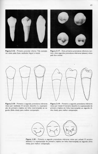45
Figura 2-16 - Primeiro premolar inferior. Três exempla-
res vistos pelas faces vestibular, lingual e mesial.
Figura 2-17 - Dois primeiros premolares inferiores (aci-
ma) e dois segundos premolares inferiores (abaixo),vistos
pela face oclusal.
Figura 2-18 - Primeiro e segundo premolares inferiores
vistos por vestibular. O terceiro desenho é a superposi-
ção do primeiro (réplica em linha interrompida) ao se-
gundo (linha cheia), para melhor comparação.
Figura 2-19 - Primeiro e segundo premolares inferiores
vistos por mesial.O terceiro desenho é a superposição do
primeiro (réplica em linha interrompida) ao segundo (li-
nha cheia), para melhor comparação.
Figura 2-20 - Primeiro e segundo premolares inferiores vistos por oclusal. O terceiro
desenho é a superposição do primeiro (réplica em linha interrompida) ao segundo (linha
cheia), para melhor comparação.
 
