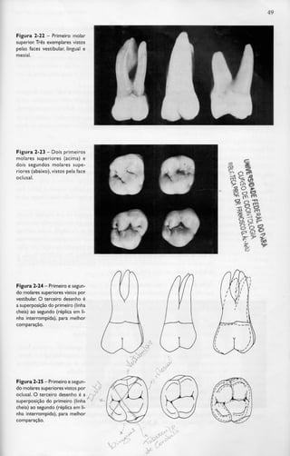 49
Figura 2-22 - Primeiro molar
superior. Três exemplares vistos
pelas faces vestibular, lingual e
mesial.
Figura 2-23 - Dois primeiros
molares superiores (acima) e
dois segundos molares supe-
riores (abaixo),vistos pela face
oclusal.
Figura 2-24 - Primeiro esegun-
do molares superiores vistos por
vestibular. O terceiro desenho é
a superposição do primeiro (linha
cheia) ao segundo (réplica em li-
nha interrompida), para melhor
comparação.
Figura 2-25 —Primeiro esegun-
do molares superiores vistos por
oclusal. O terceiro desenho é a
superposição do primeiro (linha
cheia) ao segundo (réplica em li-
nha interrompida), para melhor
comparação.
 