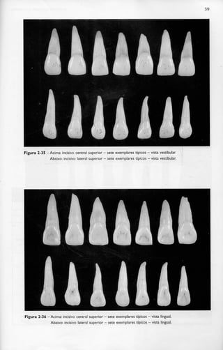 59
Figura 2-35 -Acima: incisivo central superior - sete exemplares típicos - vista vestibular.
Abaixo: incisivo lateral superior - sete exemplares típicos - vista vestibular.
Figura 2-36 -Acima: incisivo central superior - sete exemplares típicos - vista lingual.
Abaixo: incisivo lateral superior - sete exemplares típicos - vista lingual.
 