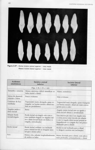 60 ANATOMIA INDIVIDUAL DOS DENTES
Figura 2-37 -Acima: incisivo central superior - vista mesial.
Abaixo: incisivo lateral superior - vista mesial.
Acidentes
anatómicos
Incisivo central
inferior _
Incisivo lateral
inferior
(Figs. 2-38, 2-39 e 2-40)
Tamanho e simetria
Sulcos de desenvol-
vimento e lobos
Contorno da face
vestibular
Ângulos mésio e
disto-incisal
Relação borda
incisal/cíngulo
Borda incisai
Raiz
Menor, simétrico (difícil identificar os
lados mesial e distai)
Pouco evidentes
Trapezoidal muito alongada, quase re-
tangular (as bordas mesial e distai ten-
dem ao paralelismo)
Retos
Borda incisai em ângulo reto com o
eixo vestíbulo-lingual (os ângulos mé-
sio e disto-incisal ficam em linha e o
cíngulo, centralizado)
Borda incisai retilínea (ou inclinada
para a mesial devido ao desgaste natu-
ral que o dente sofre)
Menor, reta, sulcada longitudinalmente
de ambos os lados
Maior, assimétrico
Mais evidentes
Trapezoidal mais alargada, quase triangular
(as bordas mesial e distai são mais conver-
gentes para o colo)
Ângulo mésio-incisal reto ou agudo e
disto-incisal obtuso e arredondado
Esta intersecção não é em ângulo reto;
a coroa parece estar torcida em relação
à raiz (o ângulo disto-incisal projeta-se
lingualmente e o cíngulo fica um pouco
deslocado para a distai)
Borda incisai inclinada para a distai
(o desgaste acentua esta inclinação)
Maior, desviada para a distai, com sulcos
mais profundos, principalmente o distai
 