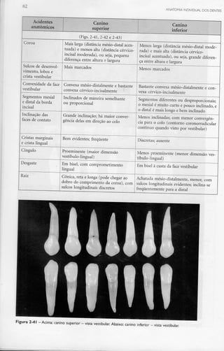 62 ANATOMIA INDIVIDUAL DOS DENTES
Acidentes
anatómicos
Coroa
Sulcos de desenvol-
vimento, lobos e
crista vestibular
Convexidade da face
vestibular
Segmentos mesial
e distai da borda
incisai
Inclinação das
faces de contato
Cristas marginais
e crista lingual
Cíngulo
Desgaste
Raiz
Canino
superior
(Figs. 2-41, 2-42 e 2-43)
Mais larga (distância mésio-dístal acen-
tuada) e menos alta (distância cérvico-
incisal moderada), ou seja, pequena
diferença entre altura elargura
Mais marcados
Convexa mésio-distalmente e bastante
convexa cérvico-incisalmente
Inclinados de maneira semelhante
ou proporcional
•
Grande inclinação;há maior conver-
gência delas em direção ao colo
Bem evidentes; frequente
Proeminente (maior dimensão
vestíbulo-lingual)
Em bisel, com comprometimento
lingual
Cónica, reta e longa (pode chegar ao
dobro do comprimento da coroa), com
sulcos longitudinais discretos
Canino
inferior
Menos larga (distância mésio-distal mode-
rada) e mais alta (distância cérvico-
incisal acentuada), ou seja, grande diferen-
ça entre altura elargura
Menos marcados
Bastante convexa mésio-distalmente e con-
vexa cérvico-incisalmente
Segmentos diferentes ou desproporcionais;
o mesial é muito curto e pouco inclinado, e
o distai é mais longo e bem inclinado
Menos inclinadas; com menorconvergên-
cia para o colo (contorno coronorradicular
contínuo quando visto por vestibular)
Discretas; ausente
Menos proeminente (menor dimensão ves-
tíbulo-lingual)
Em bisel à custa da face vestibular
Achatada mésio-distalmente, menor, com
sulcos longitudinais evidentes; inclina-se
frequentemente para a distai
Figura 2-41 -Acima: canino superior - vista vestibular. Abaixo: canino inferior - vista vestibular.
 