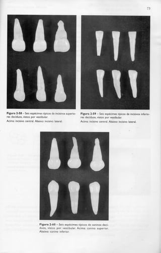 73
Figura 2-58 - Seis espécimestípicos de incisivos superio-
res decíduos,vistos por vestibular.
Acima: incisivo central. Abaixo: incisivo lateral.
Figura 2-59 - Seis espécimes típicos de incisivos inferio-
res decíduos,vistos por vestibular.
Acima: incisivo central. Abaixo: incisivo lateral.
Figura 2-60 - Seis espécimestípicos de caninos decí-
duos, vistos por vestibular. Acima: canino superior.
Abaixo: canino inferior.
 