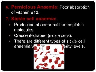 6. Pernicious Anaemia: Poor absorption
   of vitamin B12.
7. Sickle cell anaemia:
   Production of abnormal haemoglobin
    molecules
   Crescent-shaped (sickle cells).
   There are different types of sickle cell
    anaemia with different severity levels.
 